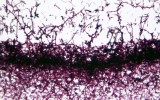 Candida Albicans